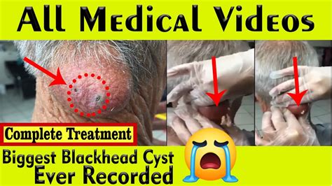 reddit blackheads|reddit blackheads and cysts videos.